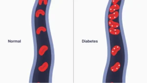 Illustration comparing two blood vessels. The left vessel, labeled 'Normal,' shows red blood cells evenly distributed. The right vessel, labeled 'Diabetes,' shows red blood cells surrounded by excess white glucose molecules, indicating high blood sugar levels.